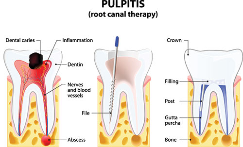 Root Canals in Newark
