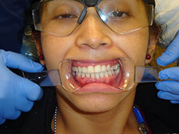 Dental Implants in Newark