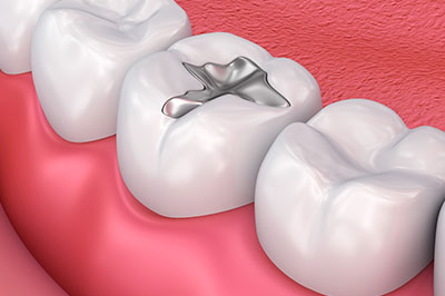 Amalgam Fillings in Newark