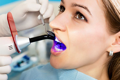 Newark dental bonding