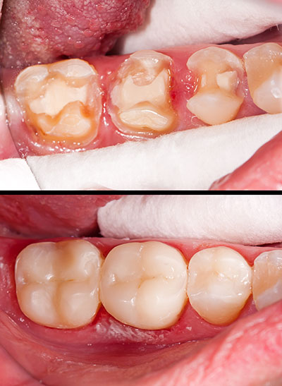 Newark Composite Fillings