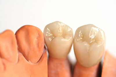 Dental Crowns in Newark