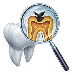 Tooth Decay in Newark