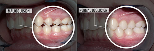 Newark Malocclusion