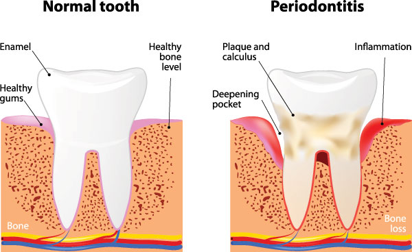 Periodontal Disease in Newark