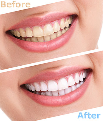 Teeth Whitening - Eastern Dental