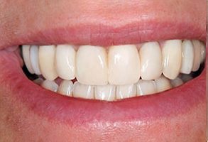 Newark Before and After Dental Bleaching