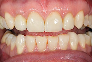 Newark Before and After Dental Braces