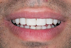 Before and After Dental Fillings in Newark