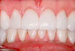 Before and After Veneers in Newark