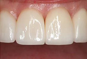 Newark Before and After Teeth Whitening