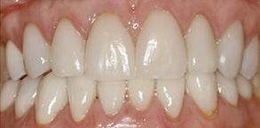 Before and After Dental Crowns in Newark