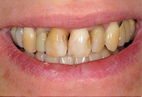Before and After Dental Bleaching in Newark