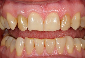 Before and After Dental Braces in Newark