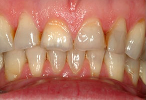 Newark Before and After Veneers