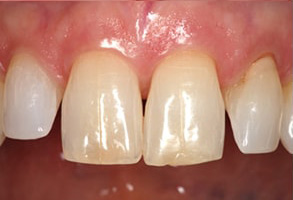 Before and After Teeth Whitening in Newark